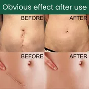 Silicone Gel Scar Patch Roll – Adjustable, Effective Scar Treatment_img_7