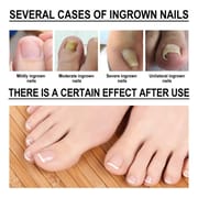 Toenail Pain Relief Kit and Fabric Softener 10ml_img_1