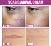 Ouhoe Scar Removing Cream (50g)_img_2
