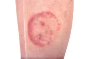 Ketofly Soap ( Indian)_img_8