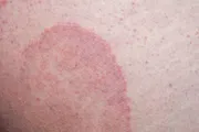Itrosted- TF Cream (Indian) - শক্তিশালী অ্যান্টিফাঙ্গাল_img_3