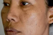 Luk Lit Cream[Indian]- মেছতা ও দাগের চিকিৎসায়_img_3