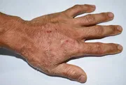 Scrabel Permethrin Soap [Indian] চুলকানি চিকিৎসায়_img_6