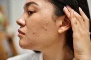 Acnetoin [Indian] Anti Acne Soap ( ব্রণের চিকিৎসায়)_img_4