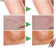 Ouhoe Scar Removal Serum 30 ml_img_2