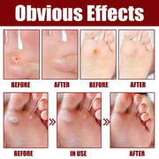 South Moon Foot Corns Exfoliating Gel Hand and Foot Wart Thorn Calluses Skin Smooth Repair and Cleaning 10 ml_img_2
