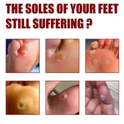 South Moon Foot Corns Exfoliating Gel Hand and Foot Wart Thorn Calluses Skin Smooth Repair and Cleaning 10 ml_img_4