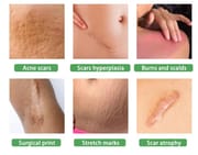 Ouhoe Scar Removal Serum 30 ml_img_0