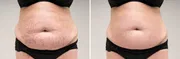 Anti Stretch Mark Cream [ মাতৃত্বের দাগ চিকিৎসায় ]_img_1