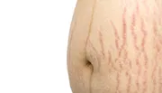 Anti Stretch Mark Cream [ মাতৃত্বের দাগ চিকিৎসায় ]_img_3