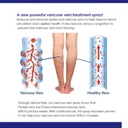 OUHOE Varicose Veins Spray._img_2