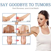 South Moon - Lipoma Remover Spray Relief Lipolysis Fat Lump With Lipoma Spray 50 ml_img_5