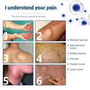 South Moon - Lipoma Remover Spray Relief Lipolysis Fat Lump With Lipoma Spray 50 ml_img_2