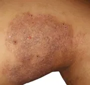 Ketosclap Soap [ Indian ] শক্তিশালী এন্টিফাংগাল_img_4
