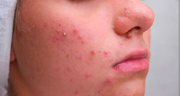 Acne Star - Benzoyel Peroxide soap [ Indian ]_img_4