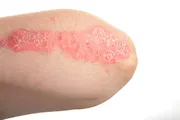 Tarcilic Soap [Indian] একজিমা এবং সোরিয়াসিস নির্মূলে_img_3