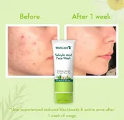 WishCare 2% Salicylic Acid with AHA, GreenTea, & TeaTree For Oliy Skin & Acne- Face Wash - 100 ml_img_3