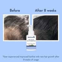 WishCare Hair Growth Serum Concentrate - 30 ml_img_1