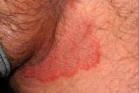 Chandani - G [স্টেরয়েডযুক্ত শক্তিশালী ক্রিম ]_img_5