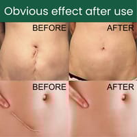 Silicone Gel Scar Patch Roll – Adjustable, Effective Scar Treatment_img_7