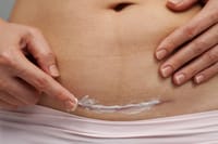 Lanbena Skin Care Gel 30g [ অপারেশন পরবর্তী কাটা দাগ নিরাময়ে ]_img_4