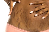 Lanbena Skin Care Gel 30g [ অপারেশন পরবর্তী কাটা দাগ নিরাময়ে ]_img_9