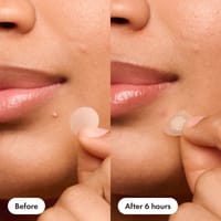 Mighty Patch Original 36pcs Pimple Patch_img_6