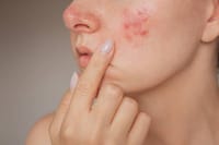 Acnetoin [Indian] Anti Acne Soap ( ব্রণের চিকিৎসায়)_img_8