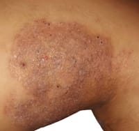 Derobin Ointment 30 gm [Indian]_img_4