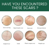 Silicone Gel Scar Patch Roll – Adjustable, Effective Scar Treatment_img_8