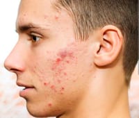 Acne Star - Benzoyel Peroxide soap [ Indian ]_img_3