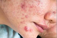 Acne Star - Benzoyel Peroxide soap [ Indian ]_img_5