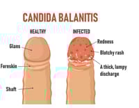 Itrosted- TF Cream (Indian) - শক্তিশালী অ্যান্টিফাঙ্গাল_img_9
