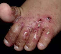 Permimite Lotion [Indian] চুলকানি ধ্বংসকারী এবং উকুননাশক_img_8