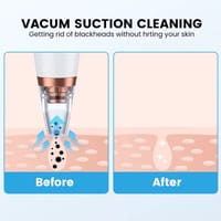 Rechargeable Blackhead Remover Machine for deep pore cleaning, acne & wrinkle removal._img_2