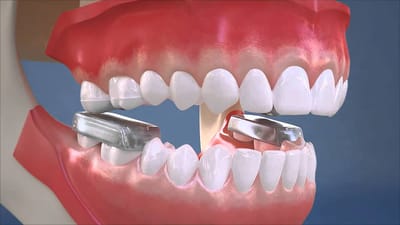 Post bite block for preparations